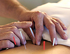 Akupunktur